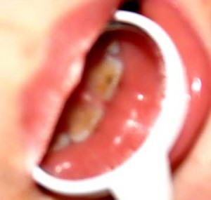 baby dental cavities front teeth